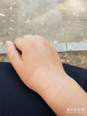 腱鞘炎手腫了[╯????╰]讓我靜靜